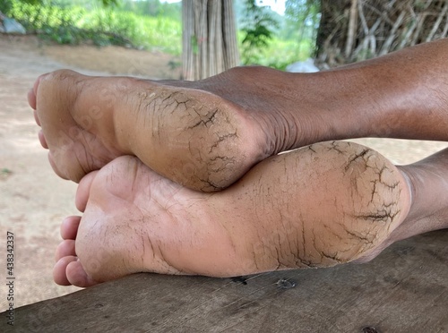 Woman dried and cracked heels.