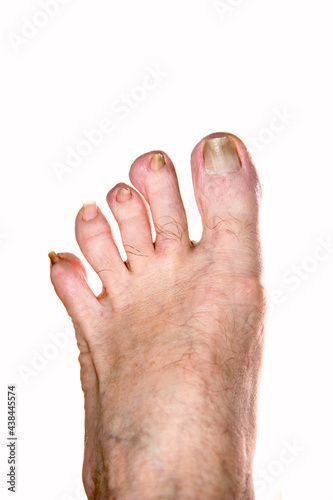 Close up of an elderly man's foot with some nail diseases. Medical examination. photo