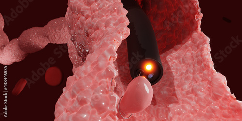 Colon Polyp Removal. Endoscope inside colonoscopy for Colon polyps search. 3d render.