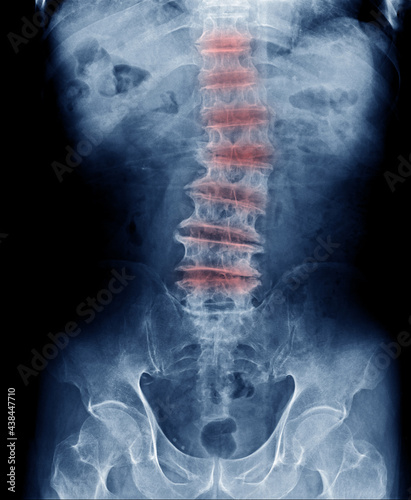 thoracic and lumbar degenerative change x-ray image, back pain in old man show x-ray image of spondylosis, spur loss of disc space and scoliosis multiple level