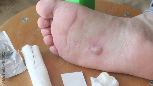 Dyshidrotic eczema on the foot, dermatitis. A man dabs a deflated bubble with an alcohol napkin. Close-up shot. photo