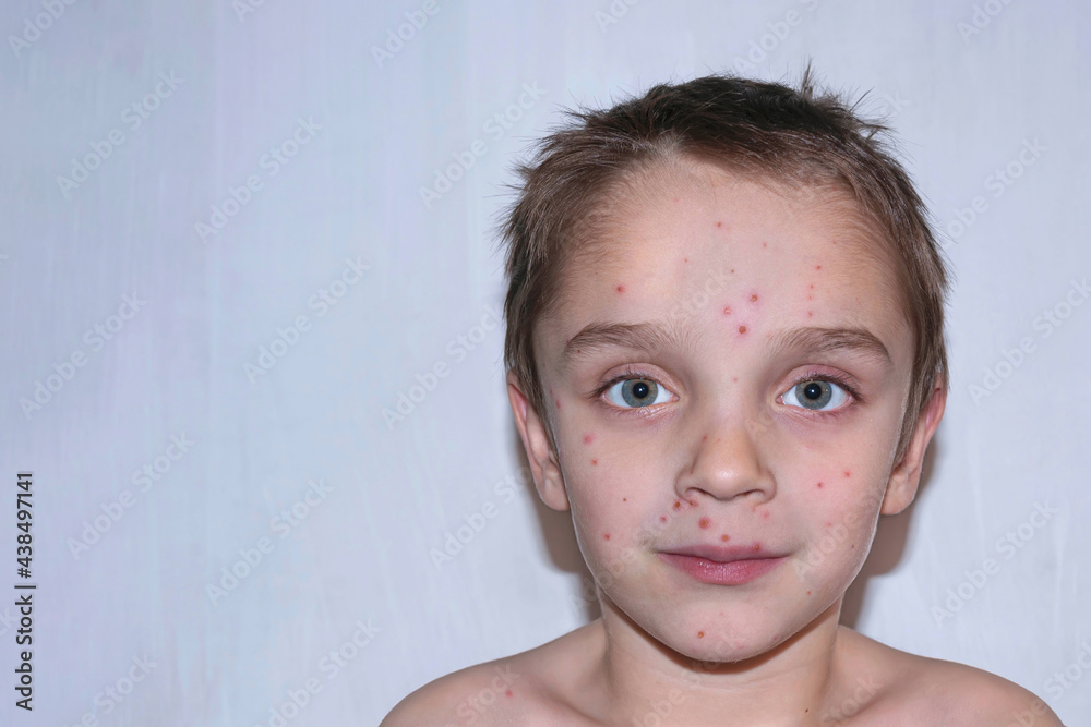 Chickenpox disease, with fever and runny nose. Boy sick on his face. Stock Photo Adobe Stock