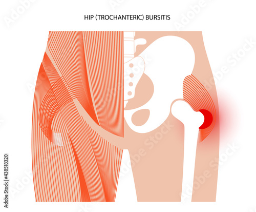 Bursitis inflammation concept