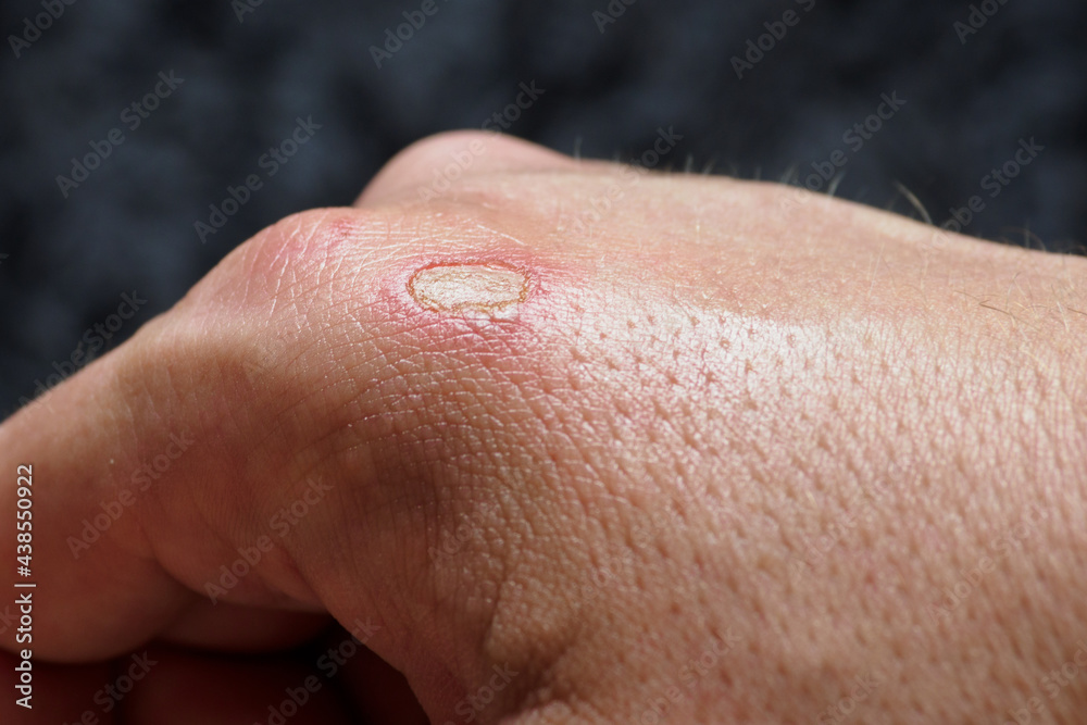 Damaged small part of the skin after a burn on a person's right hand. Damaged small part of the skin after a burn on a person's right hand.