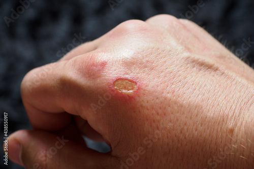 Damaged small part of the skin after a burn on a person s right hand.