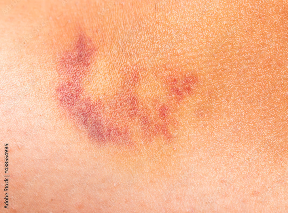 bruise on the skin bruise on the skin