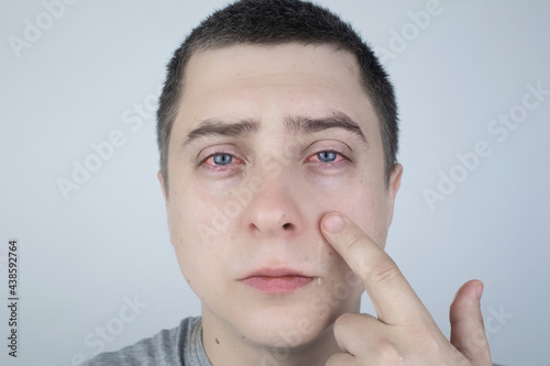 Close up of two annoyed red blood eyes of male affected by conjunctivitis or after flu, cold, allergy. Copy space for advertisement. Tired eyes after working at the computer. Close-up videos and macro