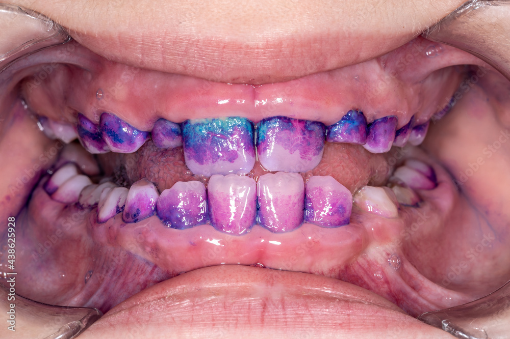 Colored plaque on a child's teeth close-up.Front view of human teeth.Permanent and deciduous teeth in the mouth.Teeth staining before professional oral hygiene treatment.