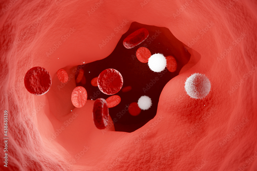 The walls of blood vessels affected by atherosclerosis. Cholesterol