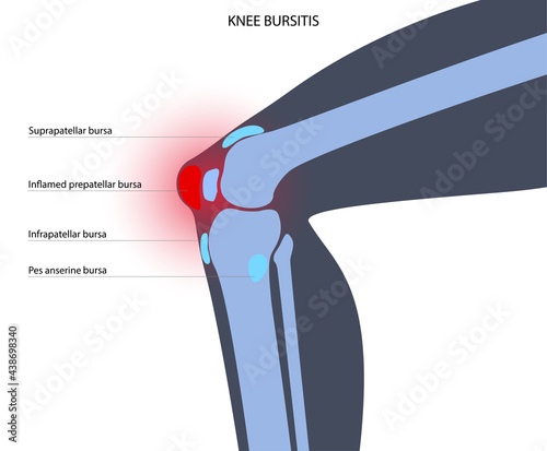 Bursitis inflammation concept