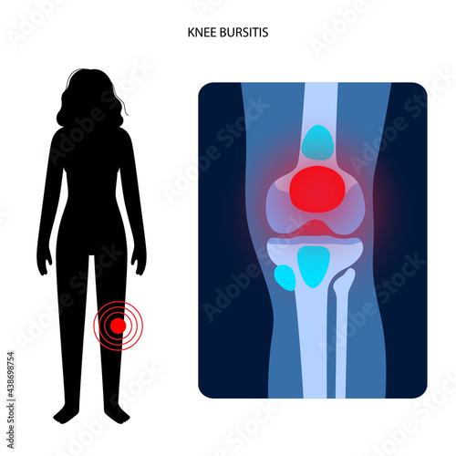Bursitis inflammation concept