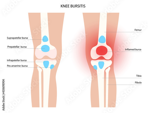 Bursitis inflammation concept