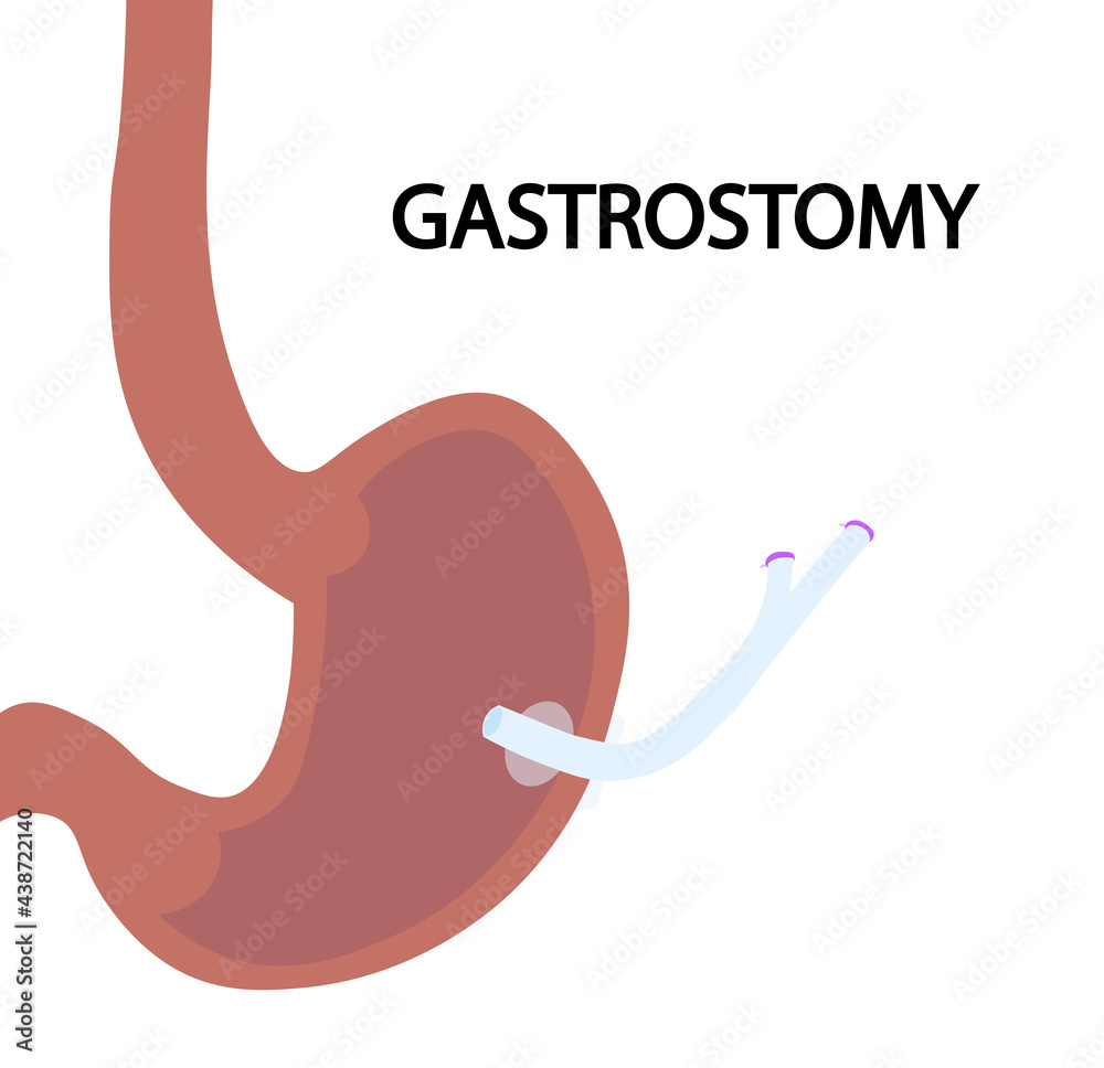 Gastrostomy illustration. Enteral nutrition feeding by gastrostomy tube