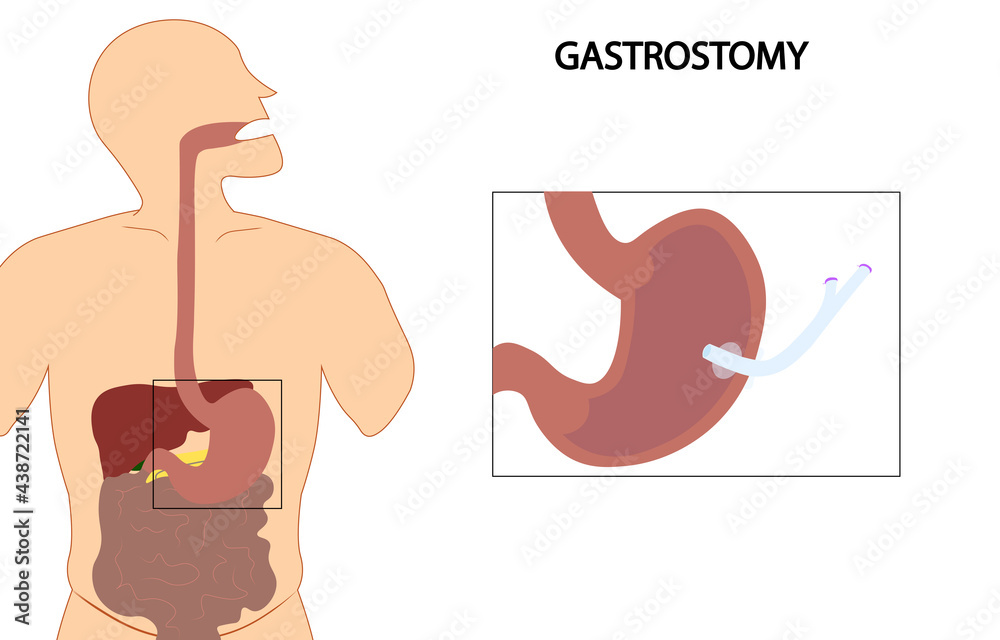Gastrostomy illustration. Enteral nutrition feeding by gastrostomy tube. ilustração do Stock