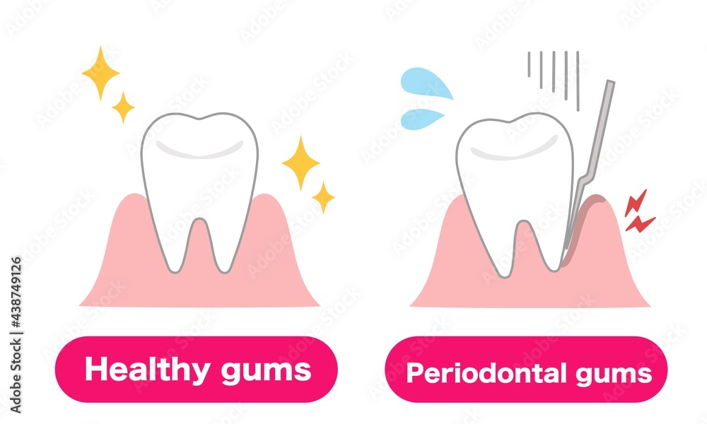 Medical illustrations of healthy gums and gums with periodontal disease Medical illustrations of healthy gums and gums with periodontal disease