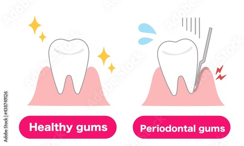 Medical illustrations of healthy gums and gums with periodontal disease