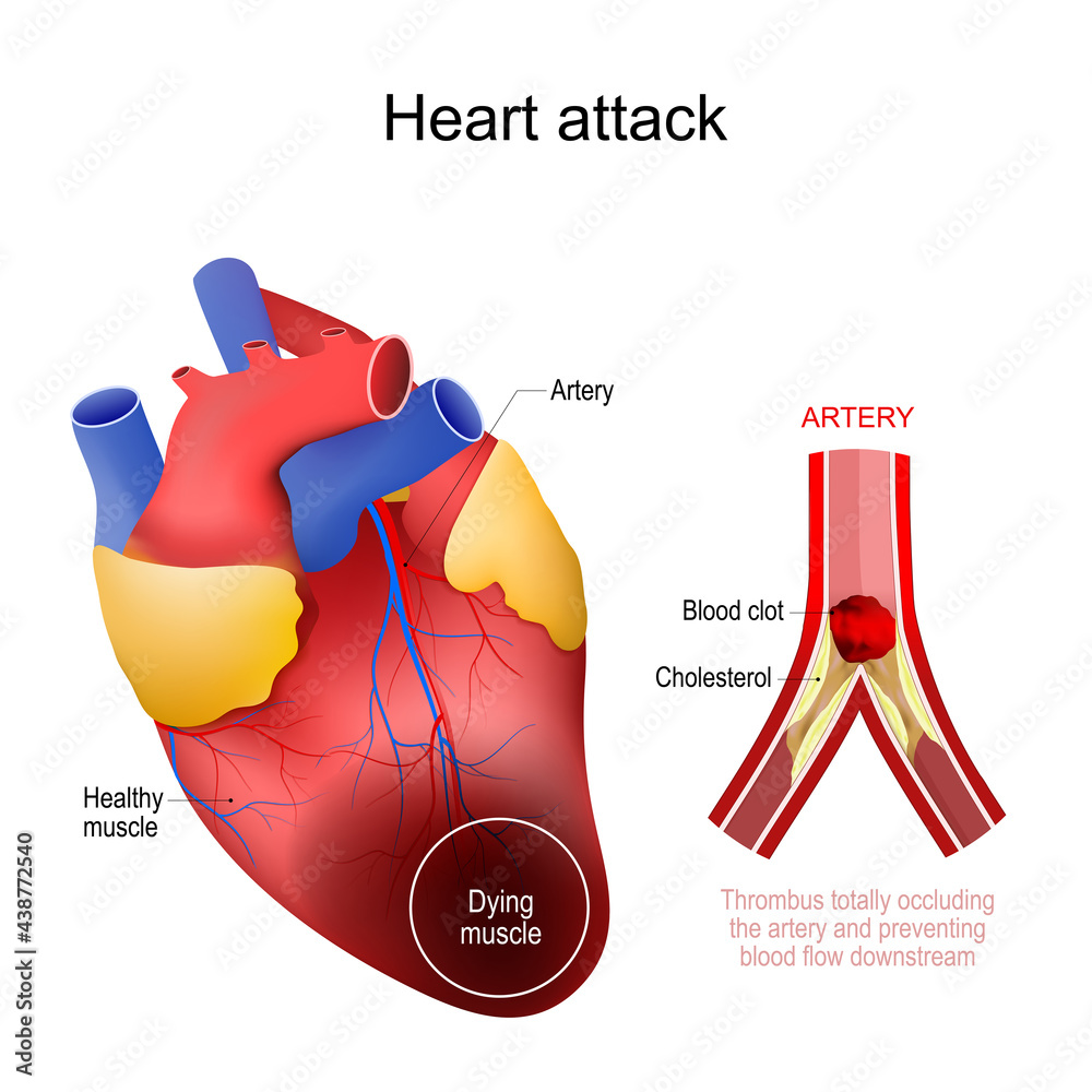 Heart Attack Myocardial Infarction Stock Vector Adobe Stock Heart Attack Myocardial Infarction Stock Vector Adobe Stock