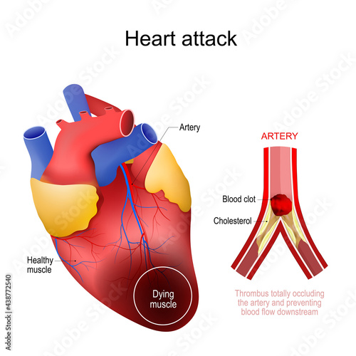Heart attack. myocardial infarction