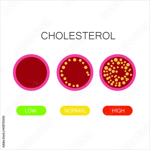 Cholesterol in artery, health risk , vector design