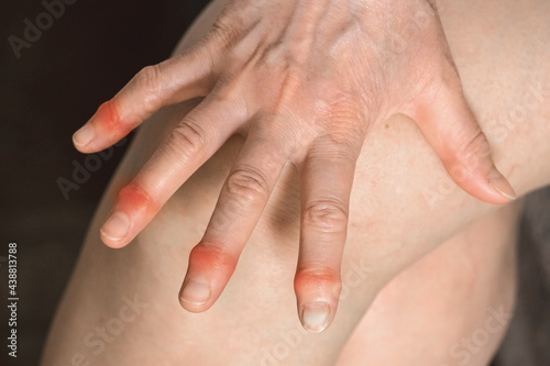 Elderly woman's hands with sore fingers. Finger treatment concept