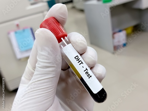 Blood sample for DHT (dihydrotestosterone) hormone test. A medical testing concept. photo