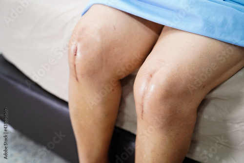 Asian senior or elderly old lady woman patient show her scars surgical total knee joint replacement Suture wound surgery arthroplasty on bed in nursing hospital ward  healthy strong medical concept.