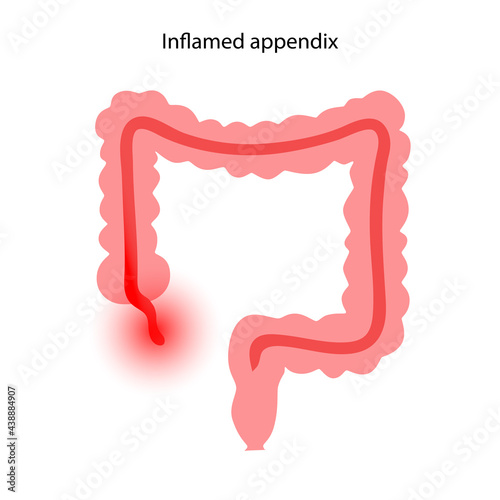 Appendix pain concept