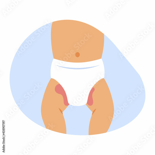 Infant with diaper rash in  groin area.Small child in diaper. Redness of  skin in children.