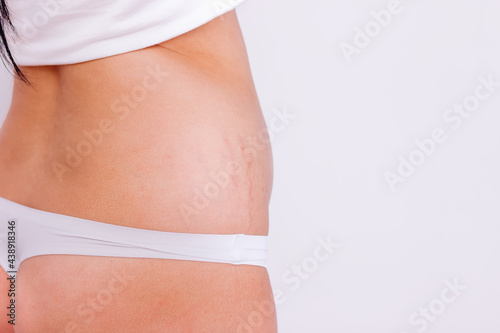 The belly of a European woman. Stretch marks on the lower abdomen and thighs after birth.