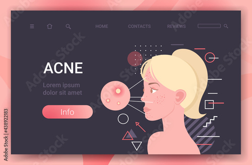 acne on woman face pore comedones cosmetology skincare problems treatment skin disease concept portrait horizontal