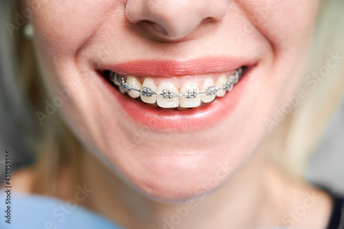 Close up of woman with charming smile demonstrating white teeth with orthodontic brackets. Female patient showing results of dental braces treatment. Concept of orthodontic treatment and dentistry. photo