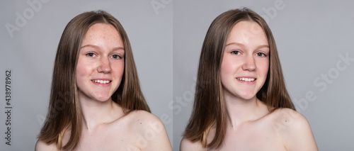 health, people, youth and beauty concept - Before and after cosmetic operation. Young pretty woman portrait. Before and after cosmetic or plastic procedure anti-age therapy, treatment photo