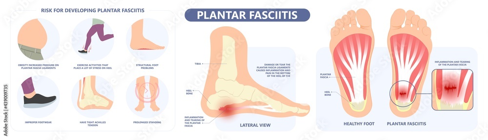 Plantar Fasciitis Heel pain run foot bone toes tear strain sport injury arch Shock Wave flat feet fallen pes planus Tendon tight hollow cavus high curved spur bony ankle band torn Plantar Fasciitis Heel pain run foot bone toes tear strain sport injury arch Shock Wave flat feet fallen pes planus Tendon tight hollow cavus high curved spur bony ankle band torn