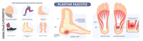 Plantar Fasciitis Heel pain run foot bone toes tear strain sport injury arch Shock Wave flat feet fallen pes planus Tendon tight hollow cavus high curved spur bony ankle band torn