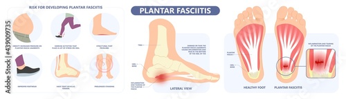 Plantar Fasciitis Heel pain run foot bone toes tear strain sport injury arch Shock Wave flat feet fallen pes planus Tendon tight hollow cavus high curved spur bony ankle band torn photo