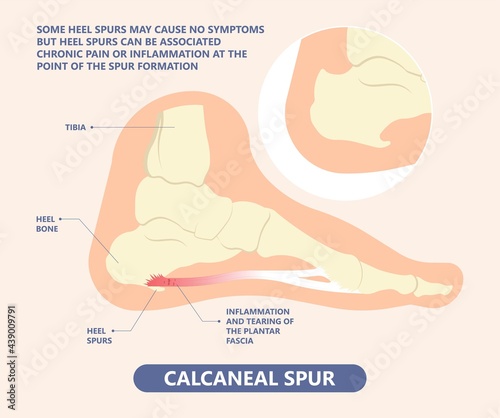 Plantar Fasciitis Heel pain run foot bone toes tear strain sport injury arch Shock Wave flat feet fallen pes planus Tendon tight hollow cavus high curved spur bony ankle band torn