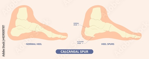 Plantar Fasciitis Heel pain run foot bone toes tear strain sport injury arch Shock Wave flat feet fallen pes planus Tendon tight hollow cavus high curved spur bony ankle band torn