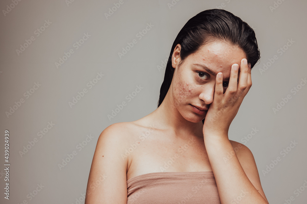 Fototapeta premium Portrait of woman with acne inflammation
