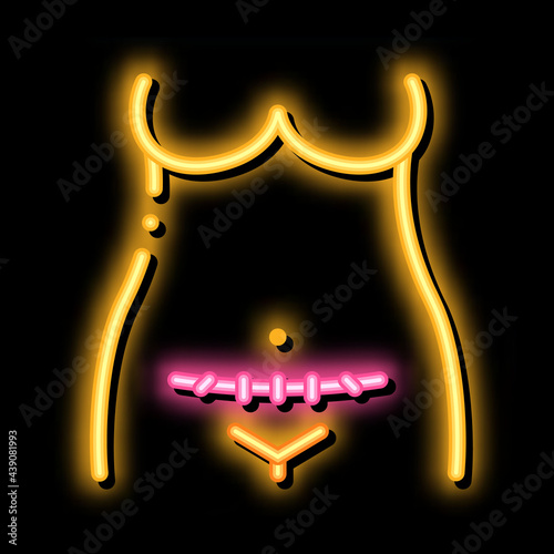 cesarean section neon light sign vector. Glowing bright icon cesarean section sign. transparent symbol illustration