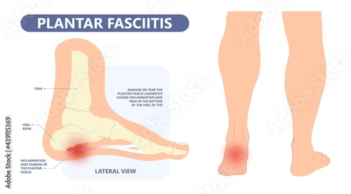 Plantar Fasciitis Heel pain run foot bone toes tear strain sport injury arch Shock Wave flat feet fallen pes planus Tendon tight hollow cavus high curved spur bony ankle band torn