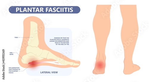 Plantar Fasciitis Heel pain run foot bone toes tear strain sport injury arch Shock Wave flat feet fallen pes planus Tendon tight hollow cavus high curved spur bony ankle band torn photo