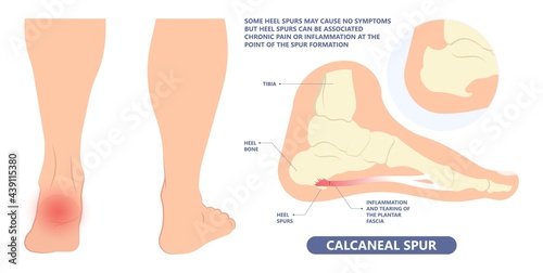 Plantar Fasciitis Heel pain run foot bone toes tear strain sport injury arch Shock Wave flat feet fallen pes planus Tendon tight hollow cavus high curved spur bony ankle band torn photo