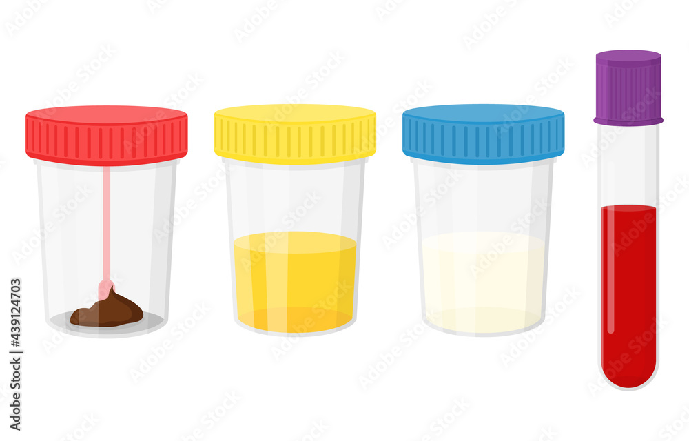 Laboratory tests. Test urine, feces, semen, and blood in plastic jars with colored lids Laboratory tests. Test urine, feces, semen, and blood in plastic jars with colored lids