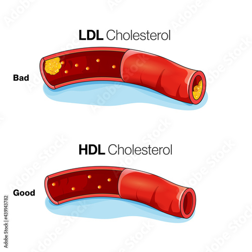 Low density lipoprotein & high-density lipoprotein action in blood vessel illustration.  photo