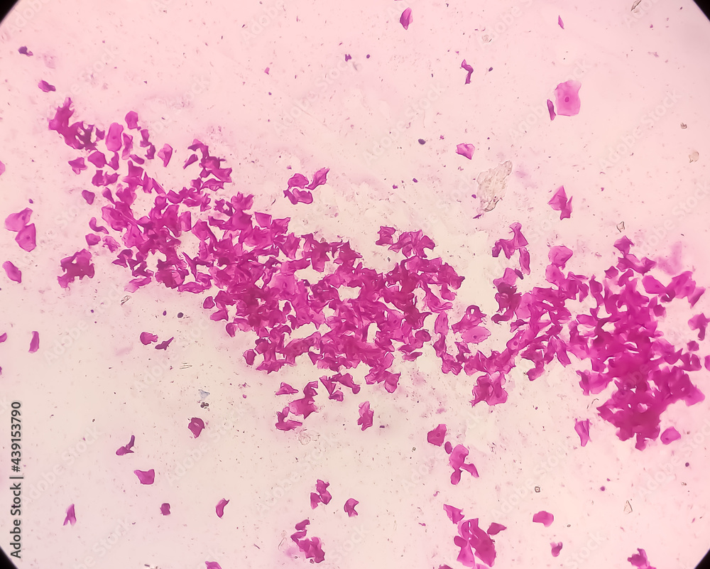 Microscopic view of high vaginal swab Gram stain smear, 10x. diagnosis of Bacterial vaginosis (BV)