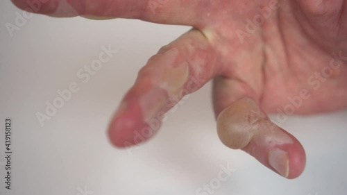 Burn of a man's hand with hot water 