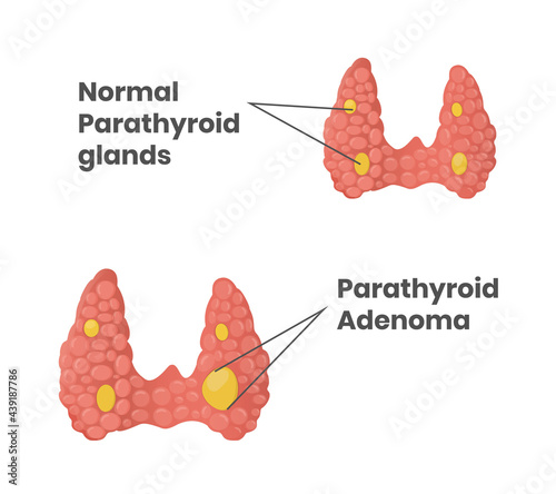 Normal parathyroid glands with parathyroid adenoma photo