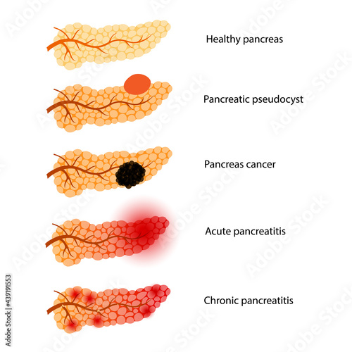 Pancreas disease and cancer photo