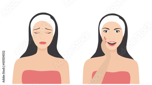 Suffering woman with acne face and happy woman with  healthy skin.  Skin problem with facial treatment concept vector illustration