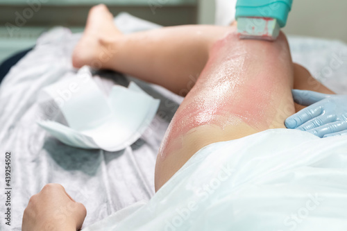 Beauty and Healthcare Ideas. Beautician Accomplishing Depilation With Hot Wax On Woman`s Leg Using Wax Device In Spa.